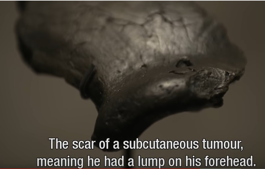 Screenshot 1lump on head b